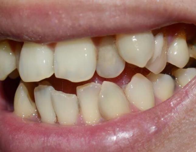 Hyperdontia: Understanding the Phenomenon of Supernumerary Teeth