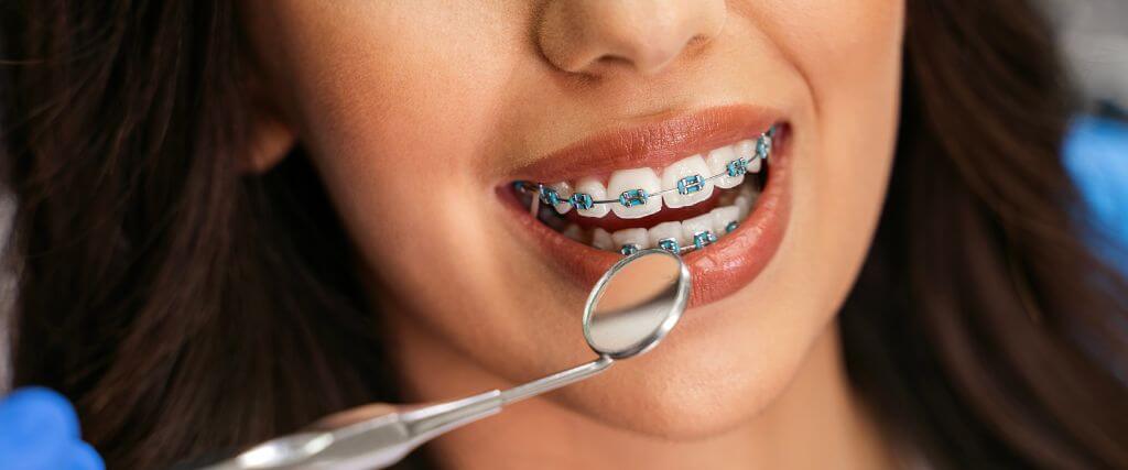 Your Guide to a Perfect Smile with Traditional Braces